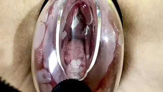 Vaginale Vaginale unter dem Einfluss einer Vakuumpumpe