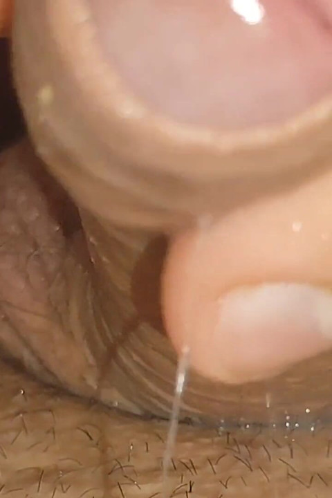 Keju Besar Berakumulasi dalam Close up Glans
