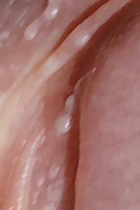 Enlargement of the Deep Urethral Hole!!