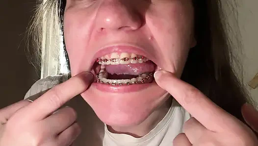 Dilinizle diş teli yalamak