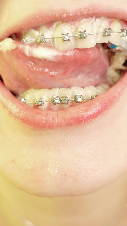 Epic moment from "eating in braces - vore and food fetish - close up video"