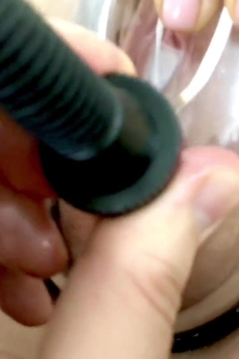 Déformation vaginale sous l'influence d'une pompe à vide