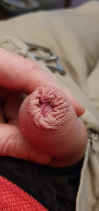 Foreskin