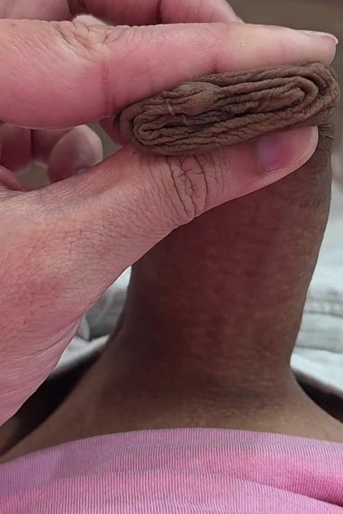 Phimosis
