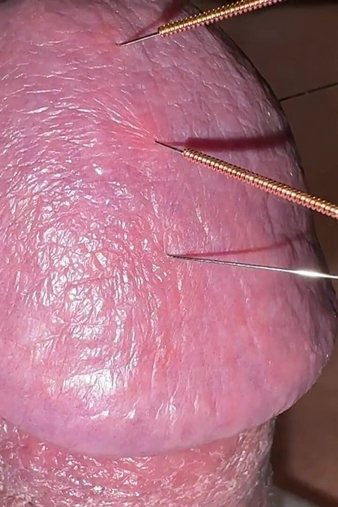 Acupuncture - Orgasm!