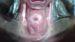 Shallow cervix penetration