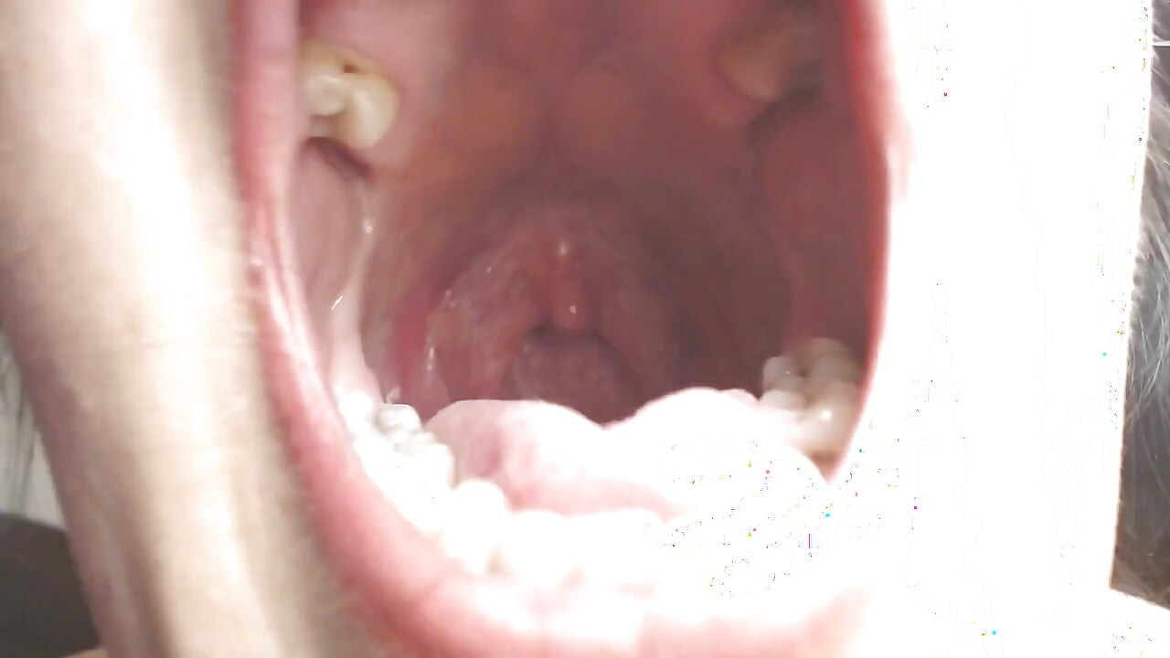 喉と口の唾、ひも、口蓋垂、扁桃腺、口蓋垂