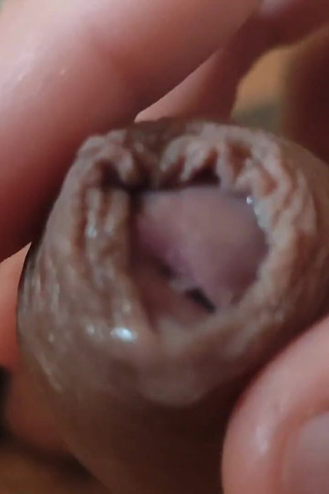 Great Phimosis Getting in the Way of the Boy's Orgasm