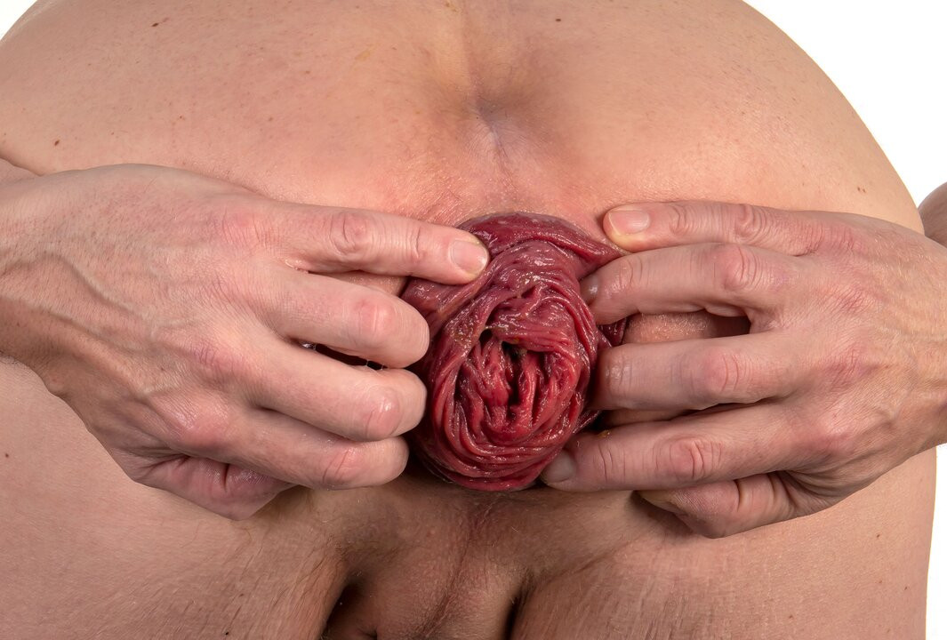 Prolapse  - Rosebud