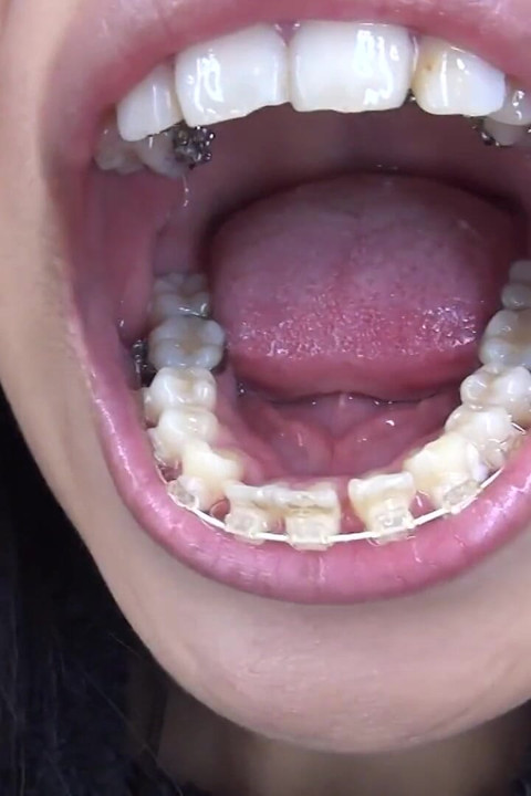 Orthodontic Teeth Fetish: Izumi Asato's Dental Fantasy