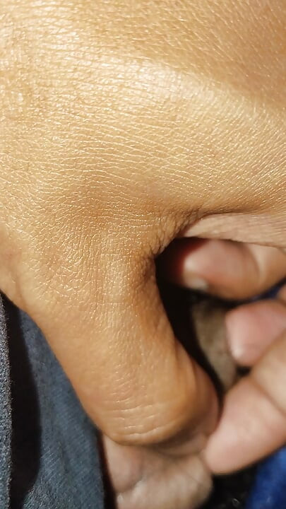 Acne on my penis I want to clean it up