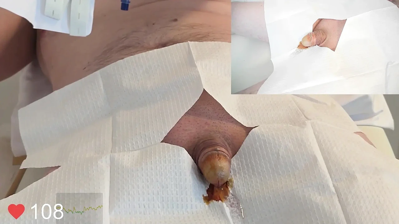 Close-up Insertion of a 16 French Foley Catheter