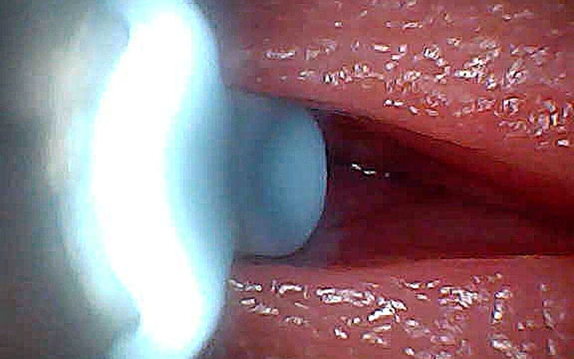 I Couldn’t Believe What Happens Inside the Penis as Sperm Passes Through (endoscopic Footage)
