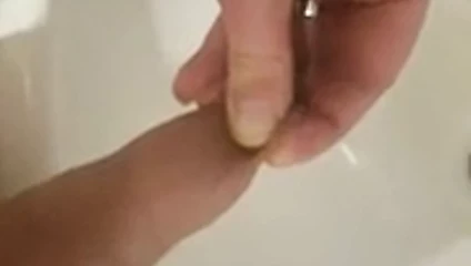 çiş balon ve precum
