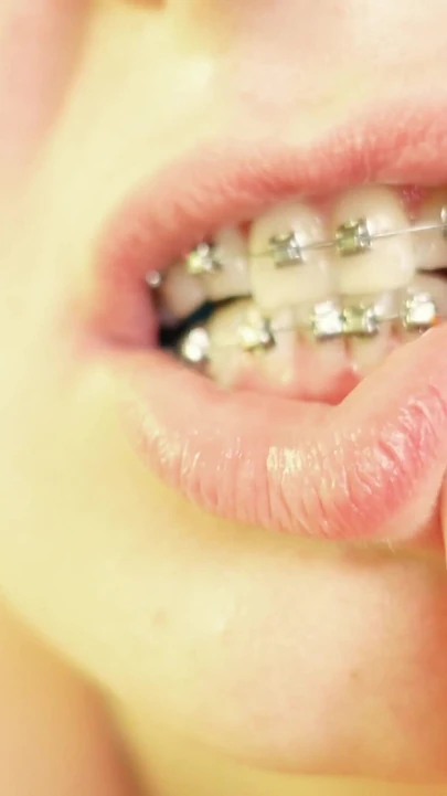 Iconic moment from "eating in braces - vore and food fetish - close up video"