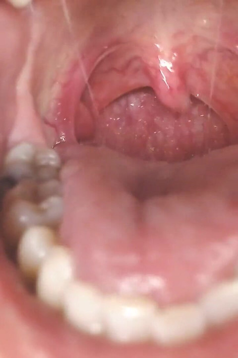 Throat and Mouth Spit Strings Uvula Tonsils Uvula
