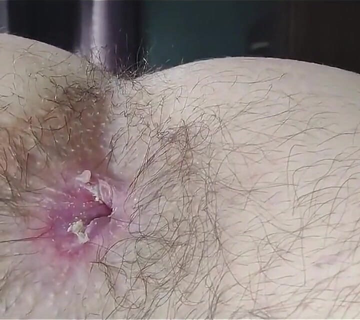 An Extreme Close-up of a Super Hairy Butt. I Haven't Cleaned Myself up Very Well, It Seems