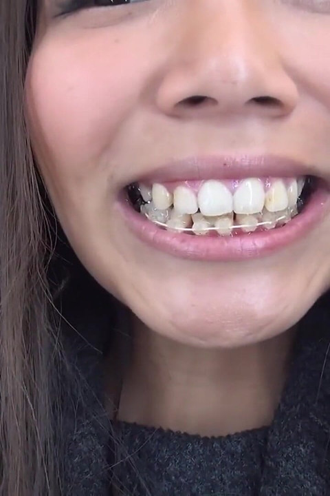 Orthodontic Teeth Fetish: Izumi Asato's Dental Fantasy