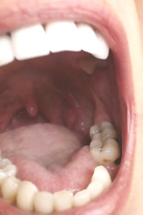 Kurkun ja suun sylkemisen kielet Uvula Risat Uvula