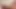 Foreskin coming soon