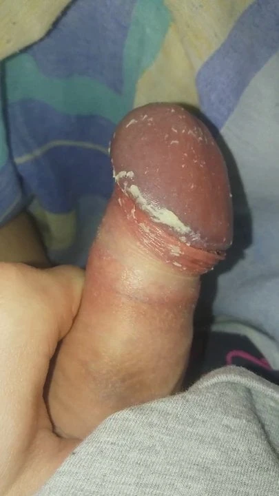Smegma cock