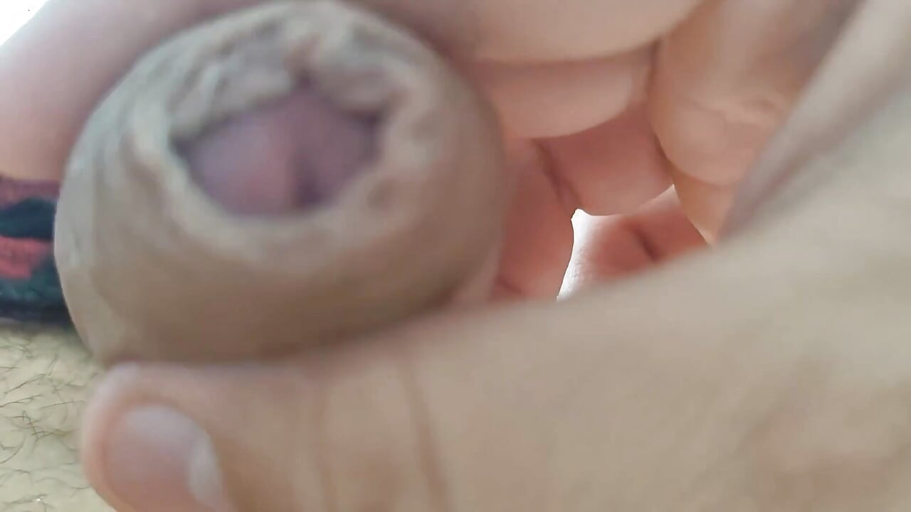 The Glans Appears Crowning Inside the Phimosis.