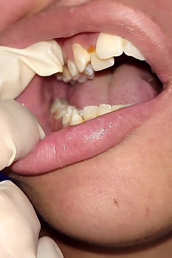 Trying to Use Dental Floss (close-up)