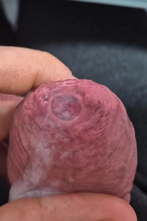 Tight Phimosis Foreskin Stretching with Cumshot!