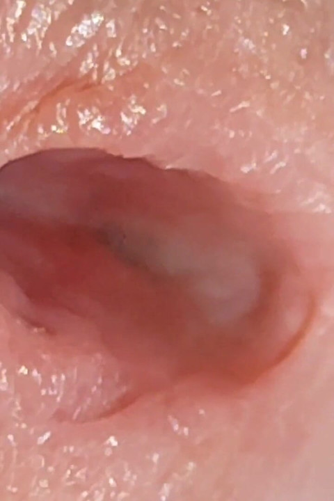 Enlargement of the Deep Urethral Hole!!