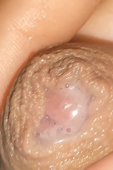Curioso Close up De Pré Cum Na Fimose Flácida.