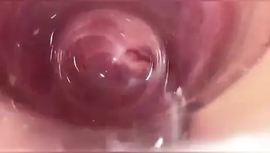 Vajinadaki kamera, rahim ağzı bakış açısı, dölleme