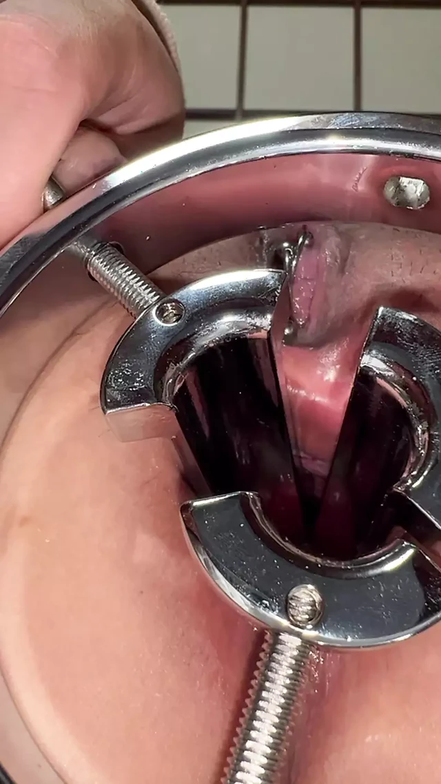 Anal opene