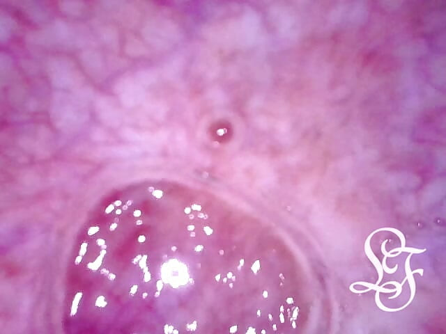 Can I fit the minicam AND a catheter inside my pee hole at the same time?