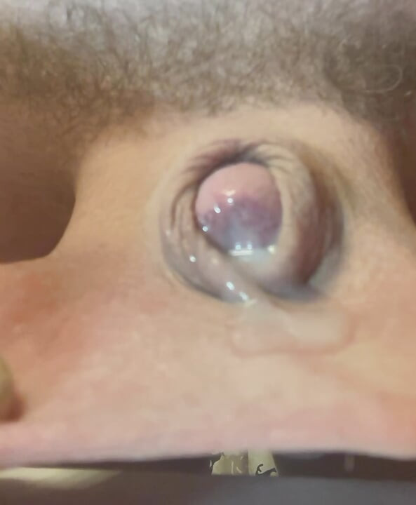 Micropenis and precum