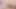 yapay penis eylem