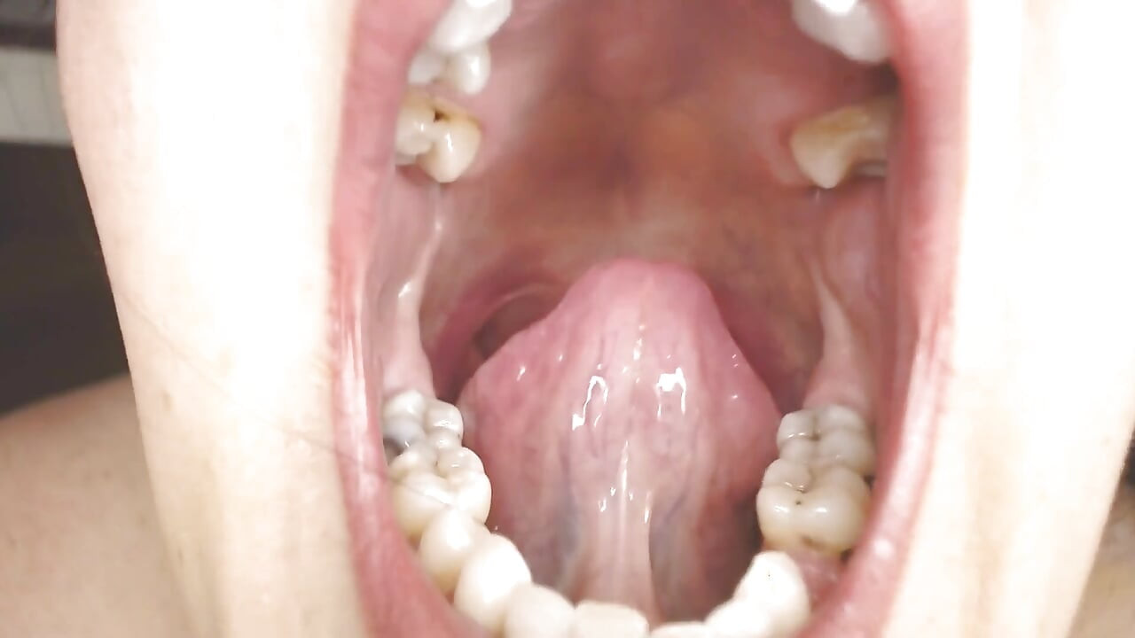 gale aur munh men thook strings uvula tonsils uvula