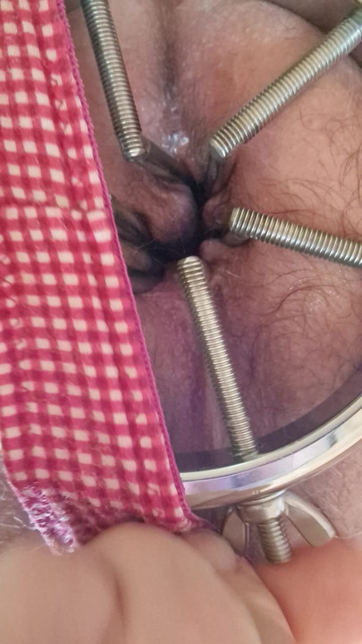 Anal dilasyon