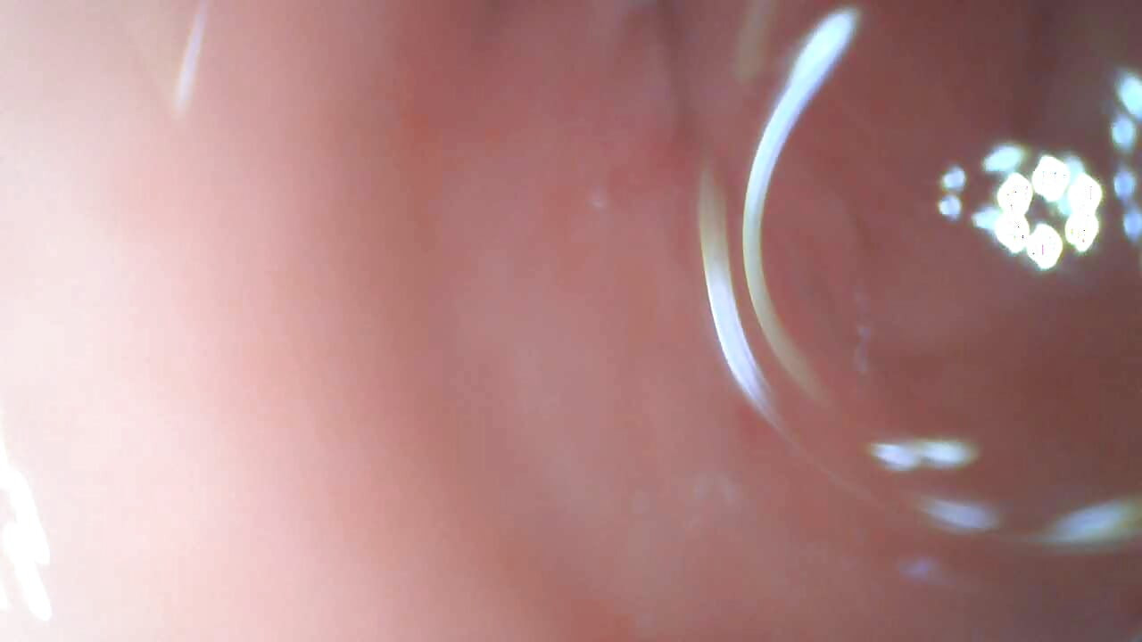 Endoscop anal