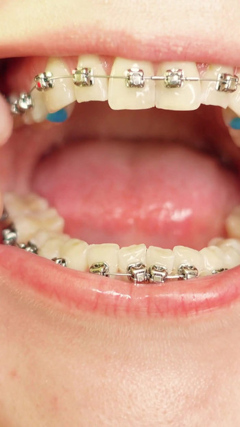 Iconic moment from "eating in braces - vore and food fetish - close up video"