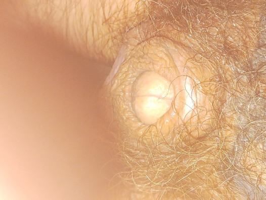 30 Fr catheter in tiny bi mtf cock