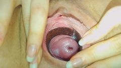 shy cervix