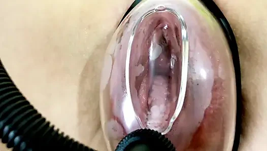 Vaginal Deformation Under the Influence of a Vacuum Pump