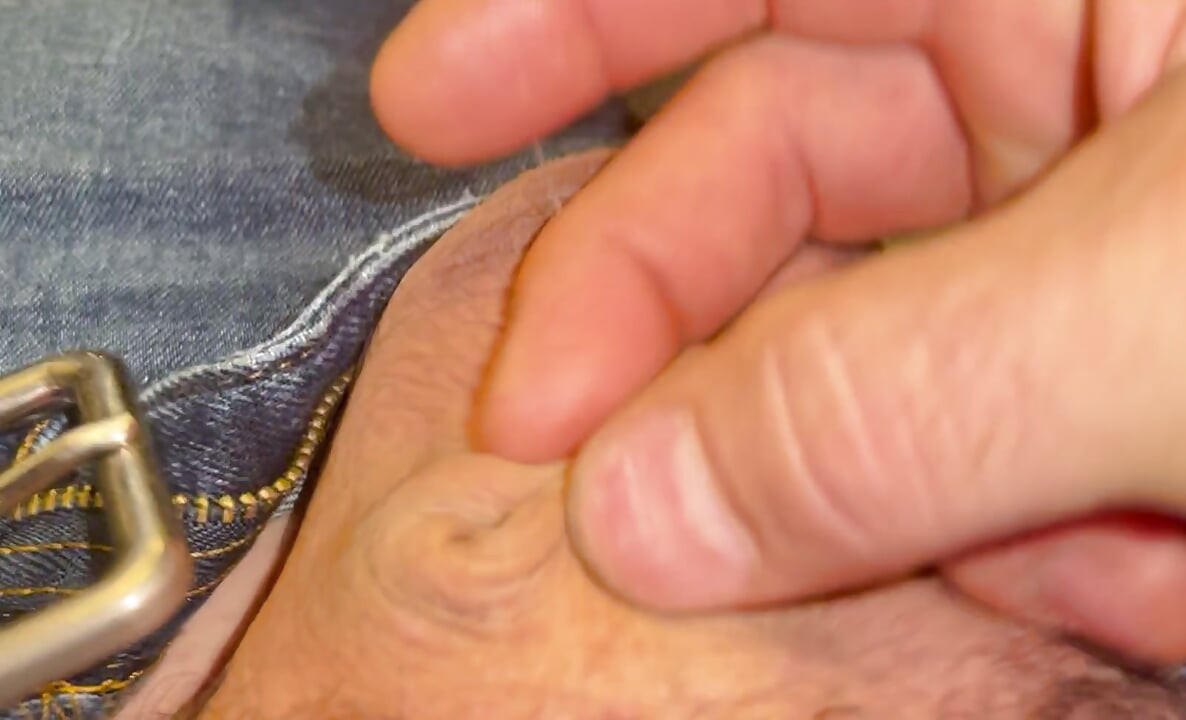 Inverted penis