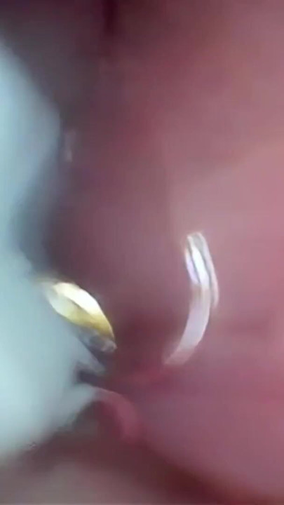 Semen in Cervix Wide Stretching Pussy Endoscope! | Clip 2