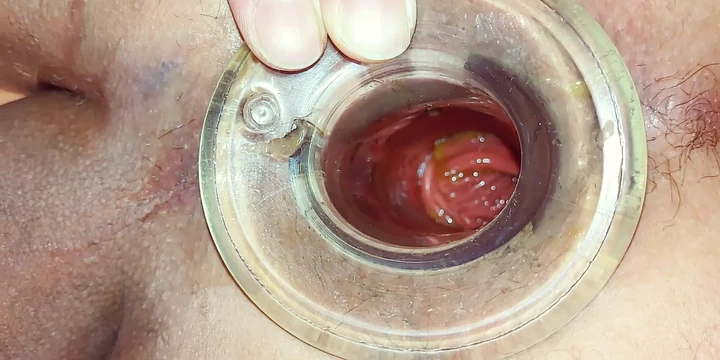 Tunnel plug