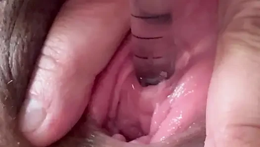 Peehole stretching