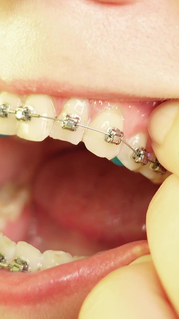 Iconic moment from "eating in braces - vore and food fetish - close up video"