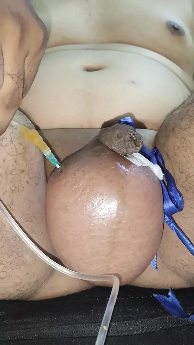 1 ltr saline infusion part 2