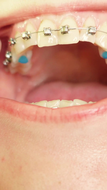 Iconic moment from "eating in braces - vore and food fetish - close up video"