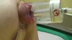 XXL anal prolapse fisting and insertions